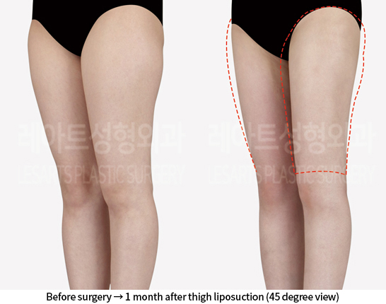 thigh_liposuction_02_05_240807