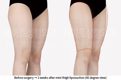 thigh_liposuction_02_05_240809
