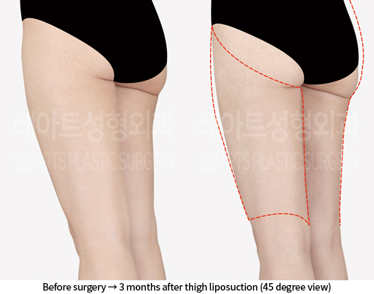 thigh_liposuction_02_05_240812