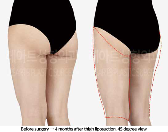 thigh_liposuction_02_05_240829