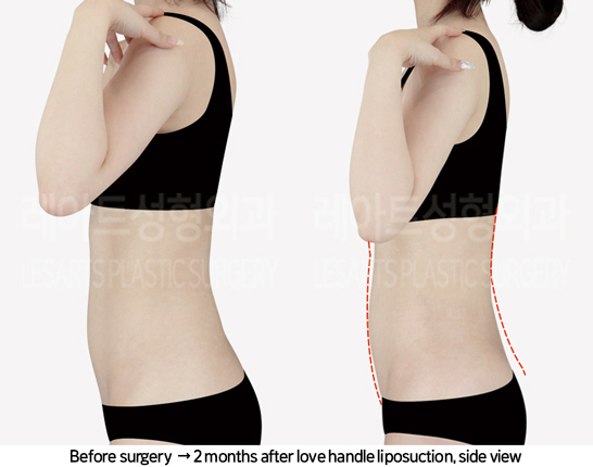 thigh_liposuction_02_05_240822