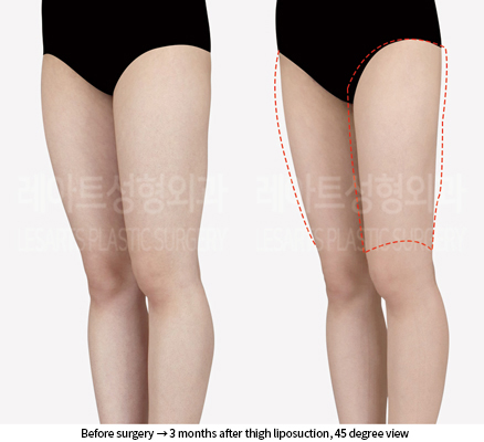 thigh_liposuction_02_05_240906