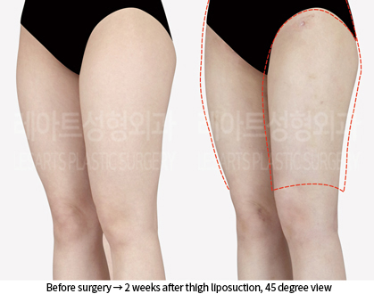 thigh_liposuction_02_05_240909