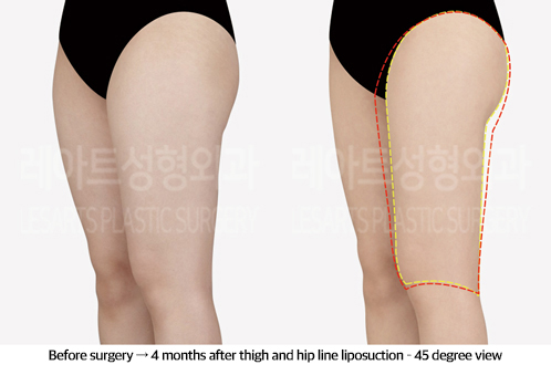 thigh_liposuction_02_05_240923