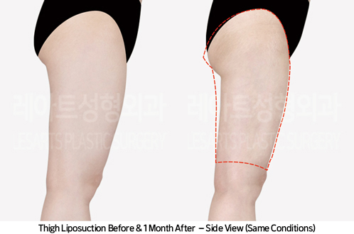 thigh_liposuction_02_05_240930