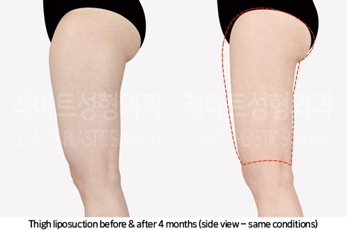 thigh_liposuction_02_05_241007