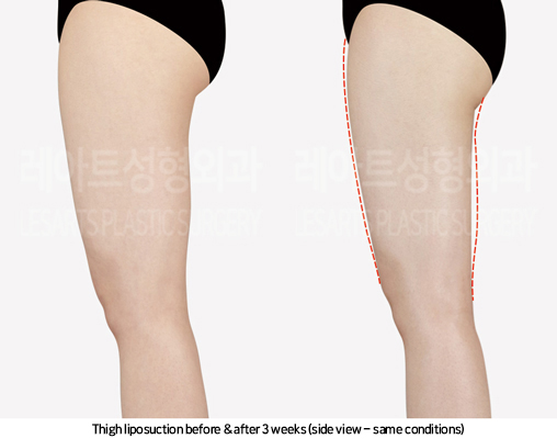 thigh_liposuction_02_05_241025