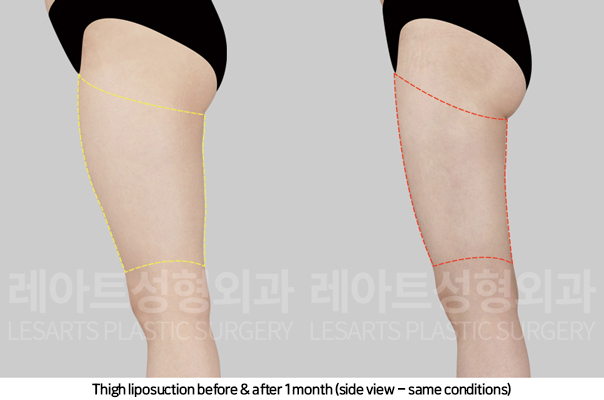 thigh_liposuction_02_05_241108