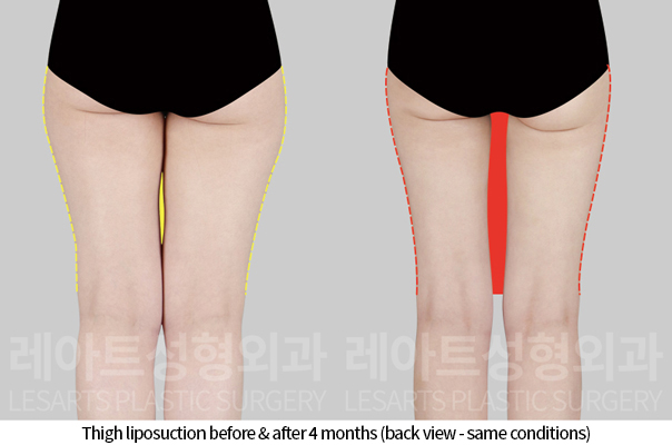 thigh_liposuction_02_05_241118