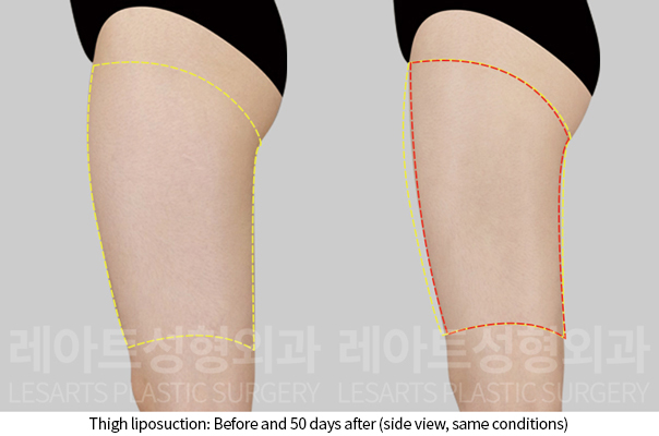 thigh_liposuction_02_05_241211