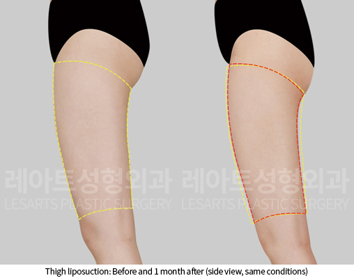 thigh_liposuction_02_05_241218