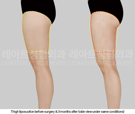 thigh_liposuction_02_05_250114