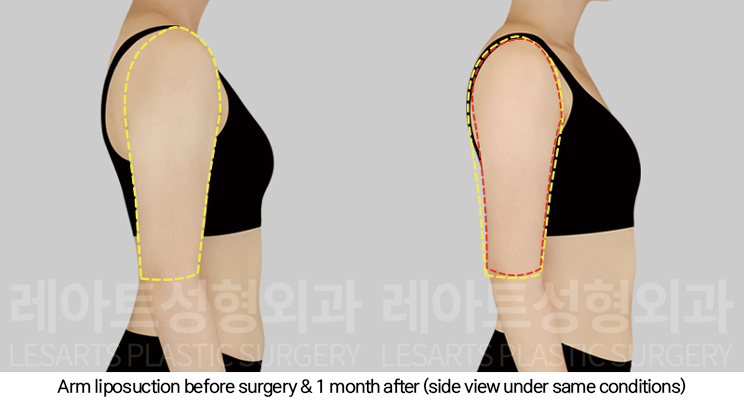 thigh_liposuction_02_05_250124