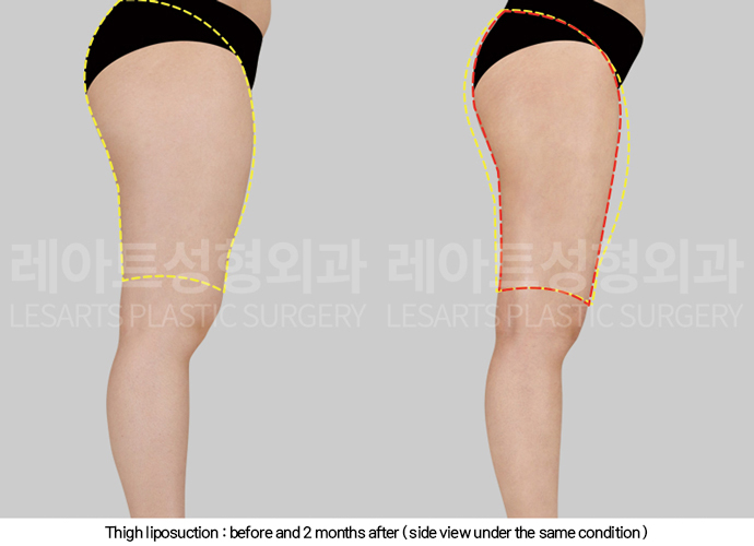 thigh_liposuction_02_05_250211