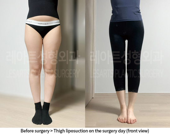 thigh_liposuction_02_06_240807