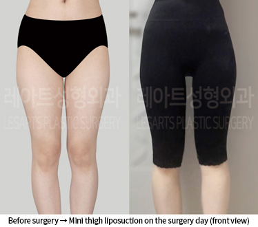 thigh_liposuction_02_06_240809