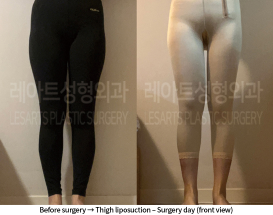 thigh_liposuction_02_06_240812
