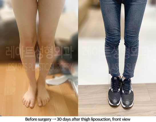 thigh_liposuction_02_06_240829