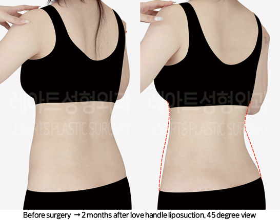thigh_liposuction_02_06_240822