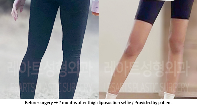 thigh_liposuction_02_06_240906