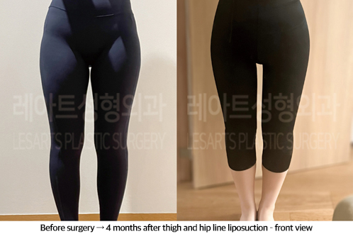 thigh_liposuction_02_06_240923