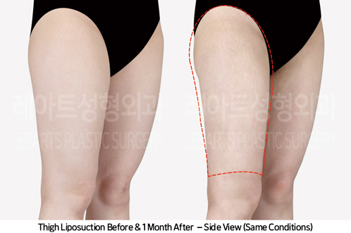 thigh_liposuction_02_06_240930