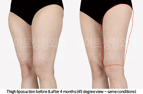 thigh_liposuction_02_06_241007