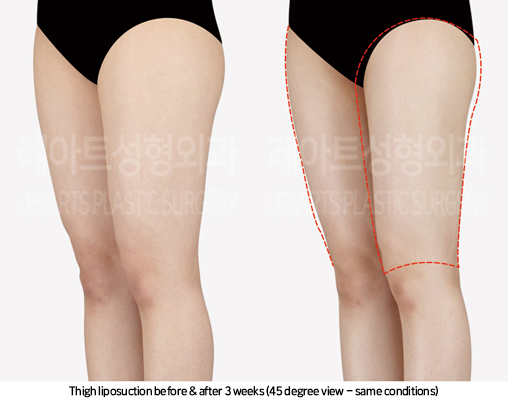 thigh_liposuction_02_06_241025
