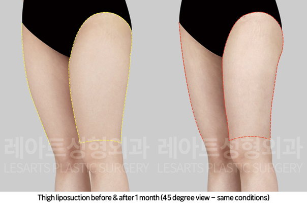 thigh_liposuction_02_06_241108