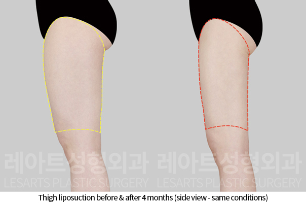 thigh_liposuction_02_06_241118