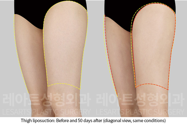 thigh_liposuction_02_06_241211