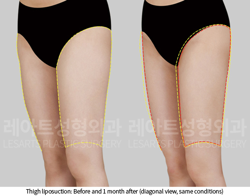 thigh_liposuction_02_06_241218