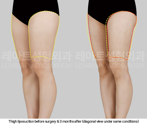 thigh_liposuction_02_06_250114