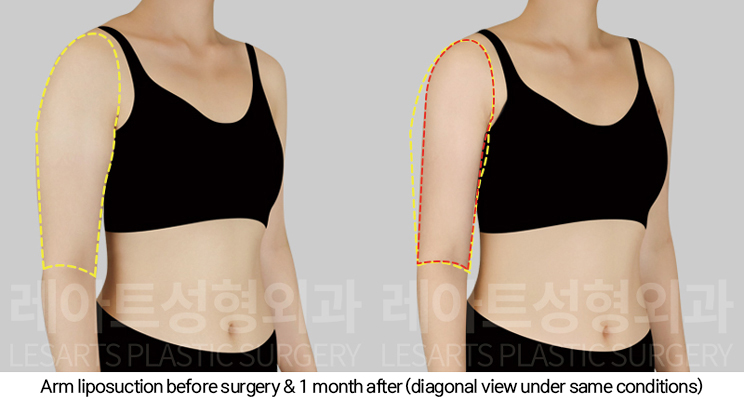thigh_liposuction_02_06_250124