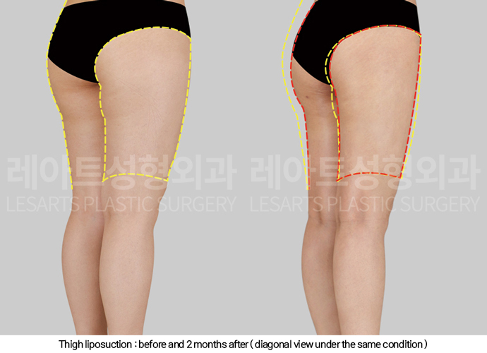 thigh_liposuction_02_06_250211