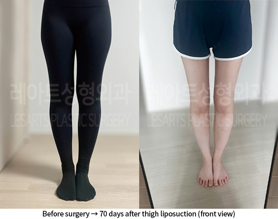 thigh_liposuction_02_07_240807