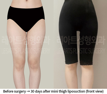 thigh_liposuction_02_07_240809