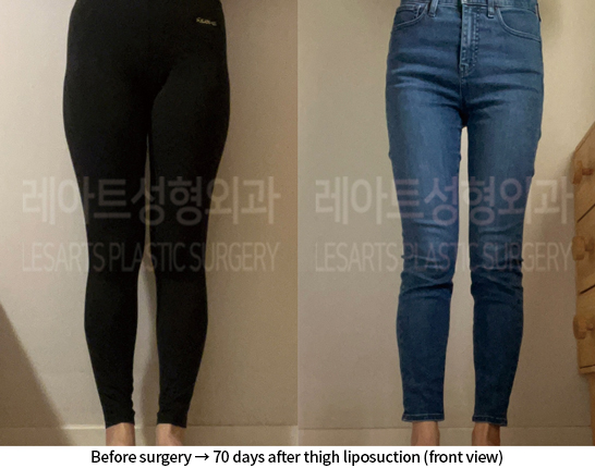 thigh_liposuction_02_07_240812