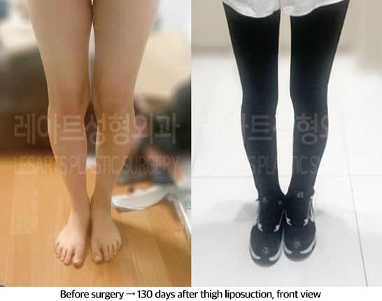 thigh_liposuction_02_07_240829
