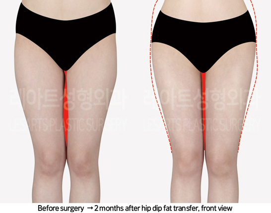 thigh_liposuction_02_07_240822