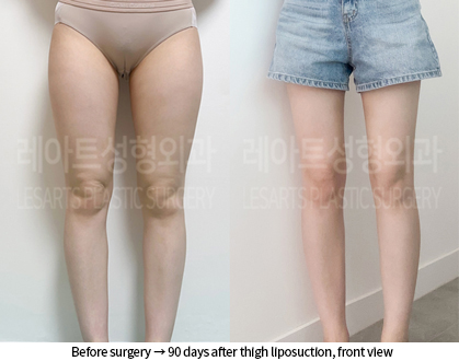 thigh_liposuction_02_07_240909
