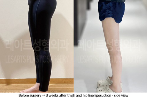 thigh_liposuction_02_07_240923