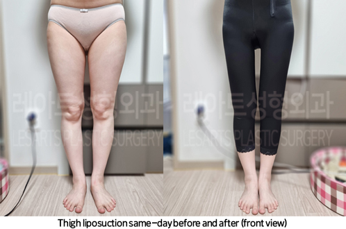 thigh_liposuction_02_07_240930
