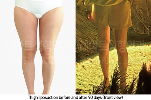 thigh_liposuction_02_07_241007