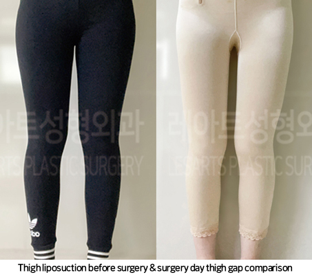 thigh_liposuction_02_07_241025