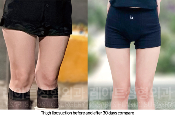 thigh_liposuction_02_07_241108
