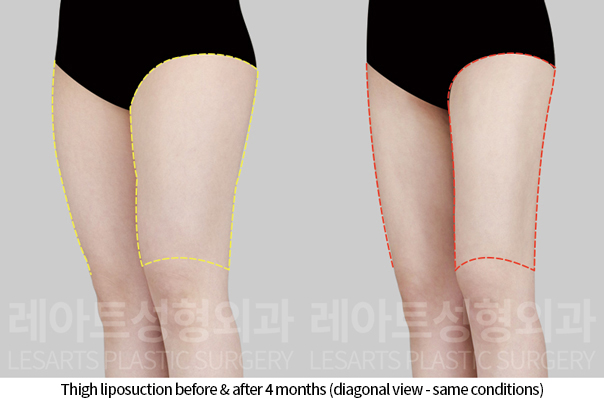 thigh_liposuction_02_07_241118
