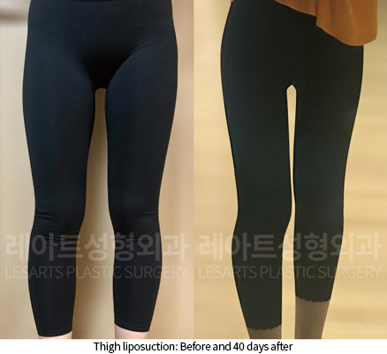 thigh_liposuction_02_07_241211