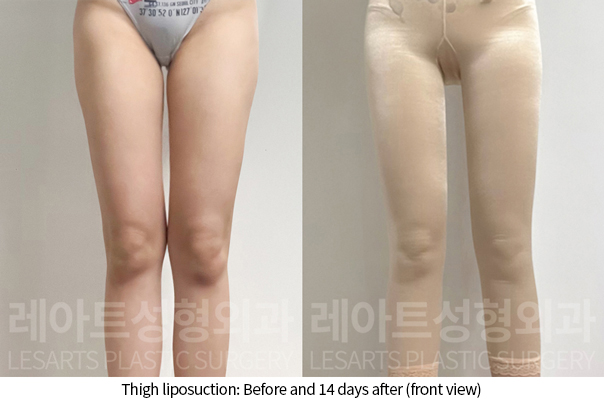 thigh_liposuction_02_07_241218