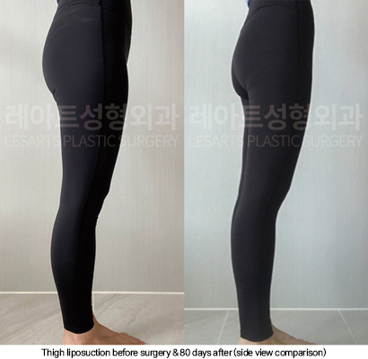 thigh_liposuction_02_07_250114